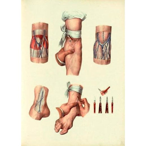 Antique Ars Medica Medical Illustration Blood Letting A3 Art