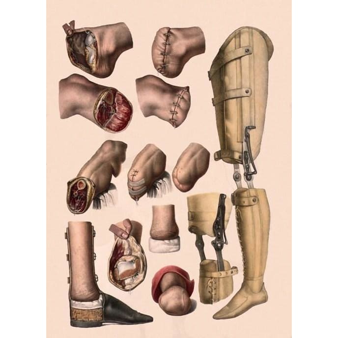 Antique Ars Medica Medical Leg & Foot Amputation A3 Reprint 